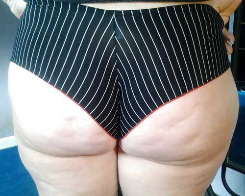 Stretch Marks and Cellulite
